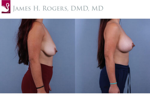 Breast Augmentation with Mastopexy (Breast Lift) Case #72887 (Image 3)