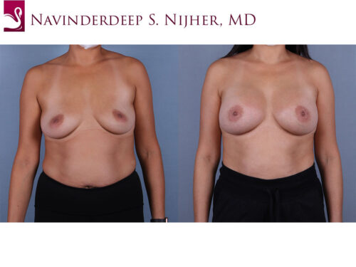 Breast Augmentation Case #60253 (Image 1)