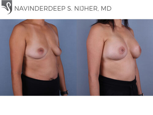 Breast Augmentation Case #60253 (Image 2)