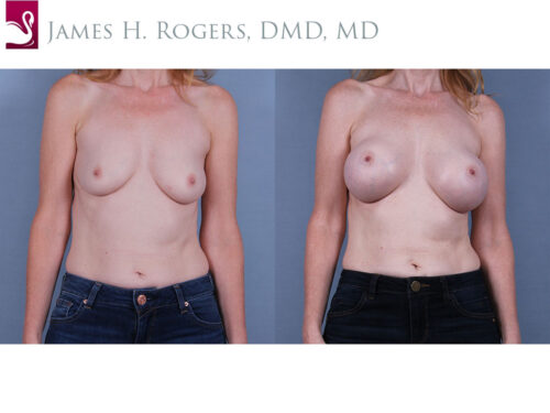 Breast Augmentation Case #71200 (Image 1)
