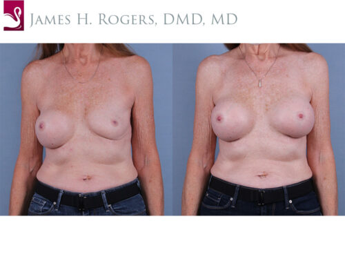 Breast Revisions Case #72226 (Image 1)