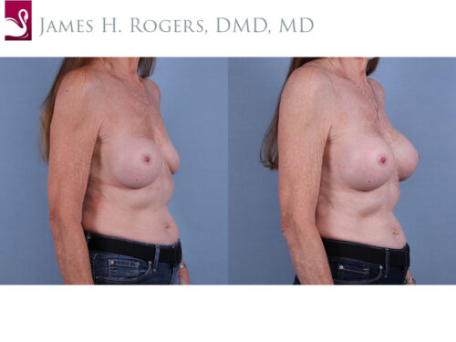 Breast Revisions Case #72226 (Image 2)