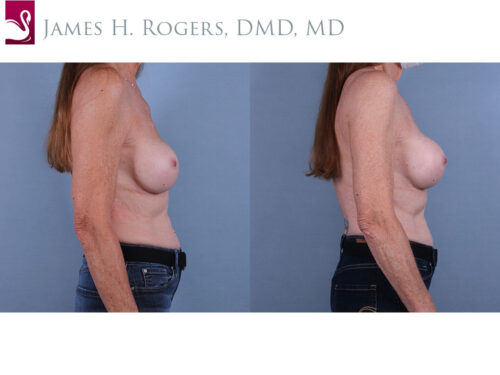 Breast Revisions Case #72226 (Image 3)
