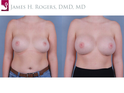 Breast Revisions Case #53292 (Image 1)