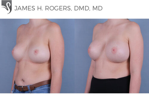 Breast Revisions Case #53292 (Image 2)