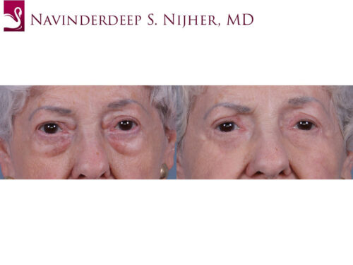 Eyelid Surgery Case #72248 (Image 1)