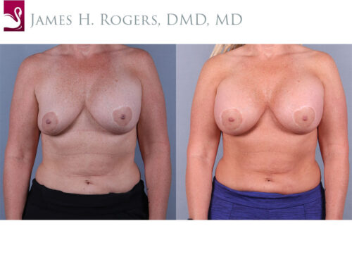 Breast Revisions Case #72941 (Image 1)
