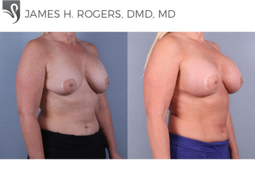 Breast Revisions Case #72941 (Image 3)