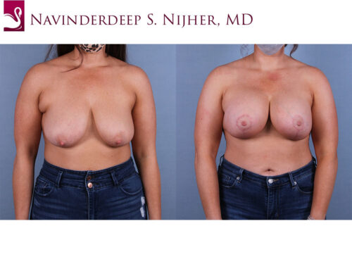 Breast Augmentation with Mastopexy (Breast Lift) Case #69267 (Image 1)