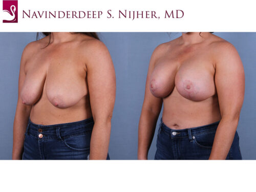 Breast Augmentation with Mastopexy (Breast Lift) Case #69267 (Image 2)