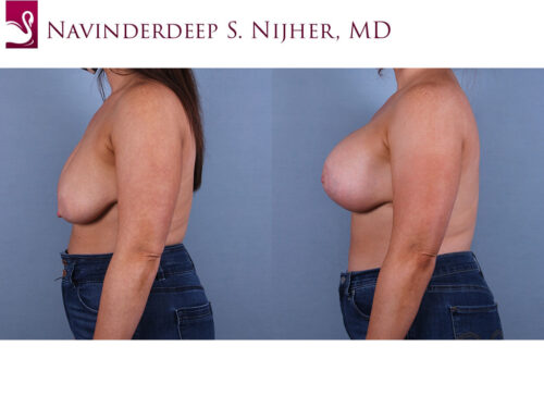 Breast Augmentation with Mastopexy (Breast Lift) Case #69267 (Image 3)