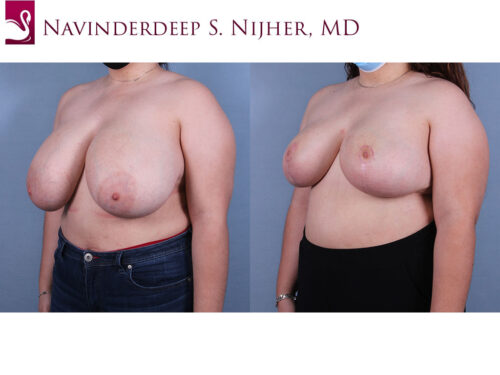 Female Breast Reduction Case #71192 (Image 2)