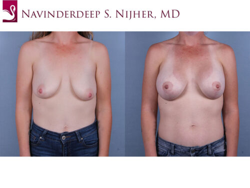 Breast Augmentation with Mastopexy (Breast Lift) Case #71555 (Image 1)