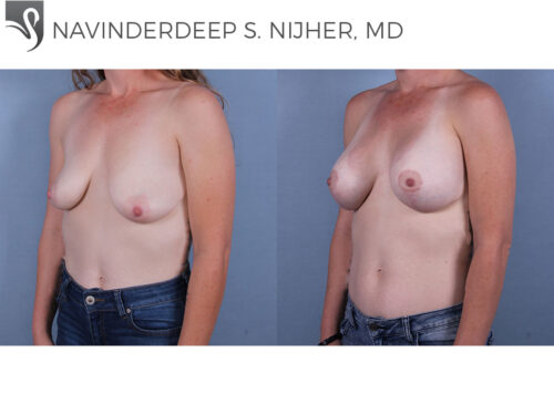 Breast Augmentation with Mastopexy (Breast Lift) Case #71555 (Image 2)