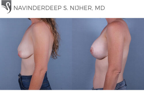Breast Augmentation with Mastopexy (Breast Lift) Case #71555 (Image 3)