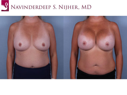 Breast Augmentation Case #74521 (Image 1)