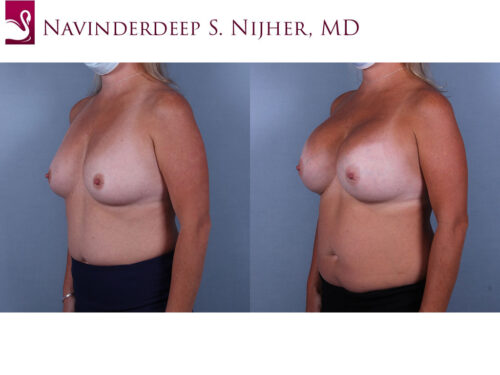 Breast Augmentation Case #74521 (Image 2)