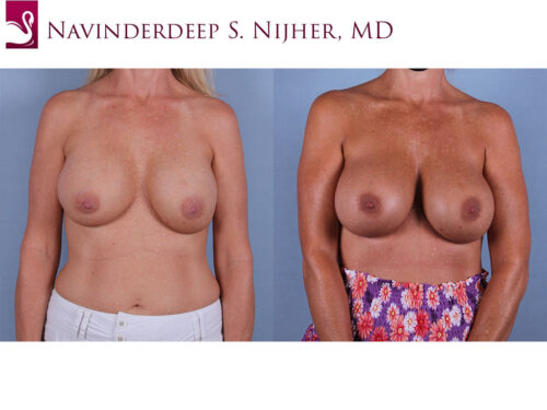 Breast Revisions Case #17081 (Image 1)
