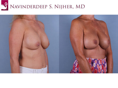 Breast Revisions Case #17081 (Image 2)