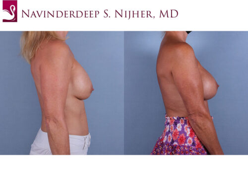 Breast Revisions Case #17081 (Image 3)