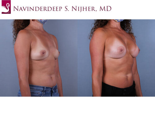 Breast Augmentation Case #73301 (Image 2)