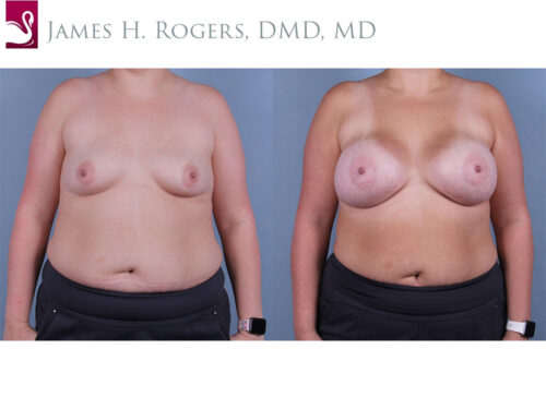 Breast Augmentation Case #61814 (Image 1)