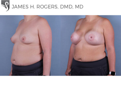 Breast Augmentation Case #61814 (Image 2)