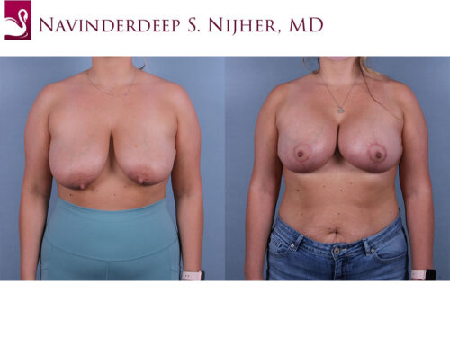 Breast Augmentation with Mastopexy (Breast Lift) Case #68238 (Image 1)
