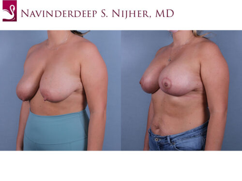 Breast Augmentation with Mastopexy (Breast Lift) Case #68238 (Image 2)
