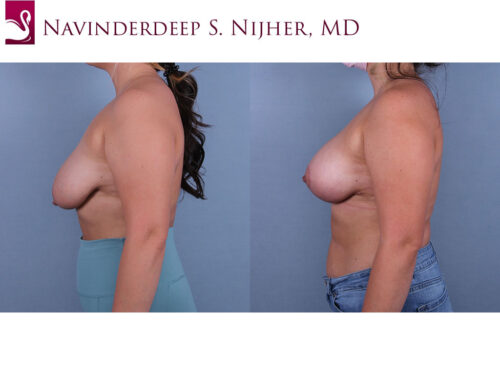 Breast Augmentation with Mastopexy (Breast Lift) Case #68238 (Image 3)