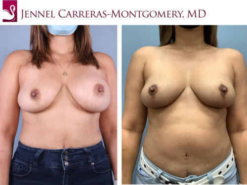 Before and after image of a real plastic surgery procedure performed by Dr. Carreras-Montgomery.