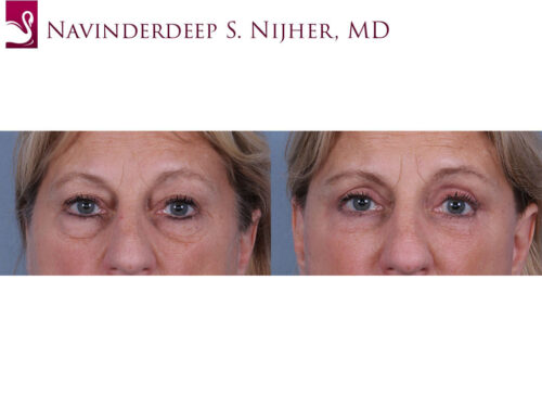 Eyelid Surgery Case #30503 (Image 1)