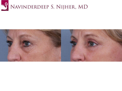 Eyelid Surgery Case #30503 (Image 2)