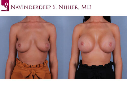 Breast Augmentation Case #72255 (Image 1)