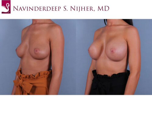 Breast Augmentation Case #72255 (Image 2)