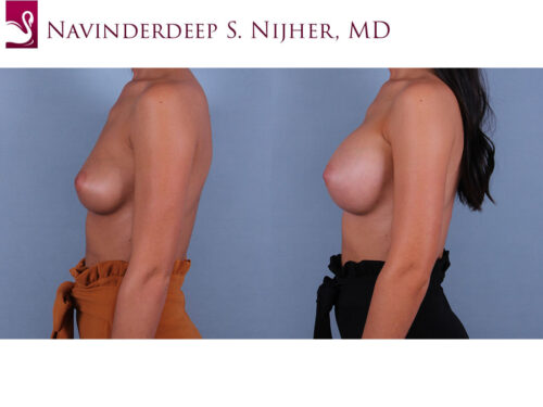 Breast Augmentation Case #72255 (Image 3)