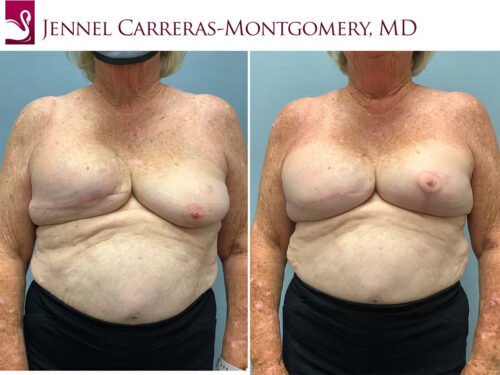 Breast Reconstruction Case #70285 (Image 1)