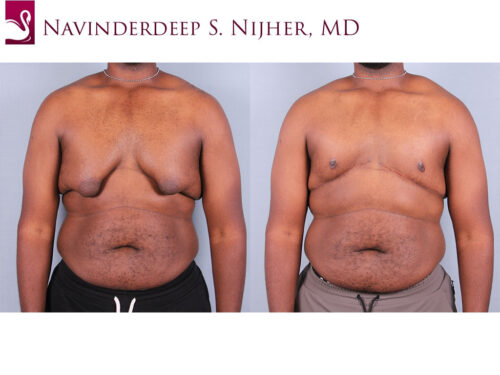 Male Breast Reduction Case #67837 (Image 1)