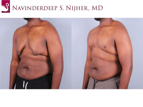 Male Breast Reduction Case #67837 (Image 2)