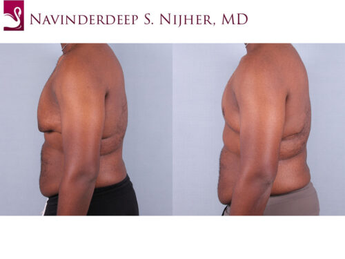 Male Breast Reduction Case #67837 (Image 3)