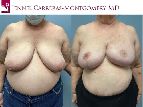 Breast Reconstruction Case #71072 (Image 1)