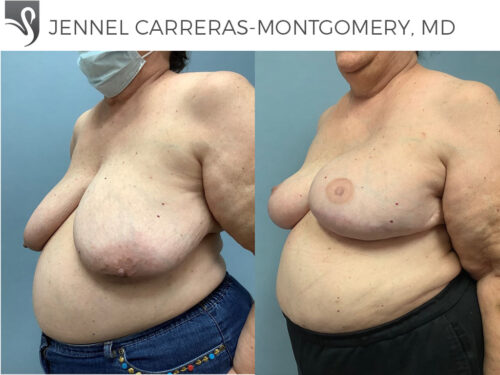 Breast Reconstruction Case #71072 (Image 2)