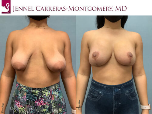 Before and after image of a real plastic surgery procedure performed by Dr. Carreras-Montgomery.