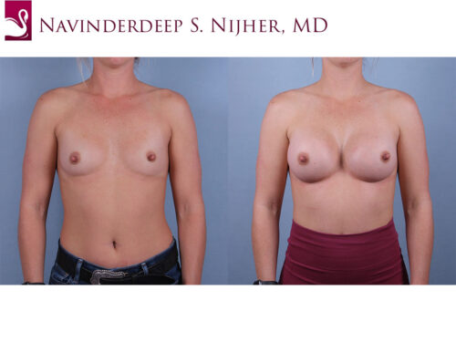 Breast Augmentation Case #74398 (Image 1)