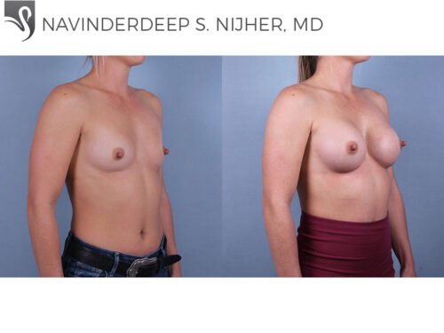 Breast Augmentation Case #74398 (Image 2)