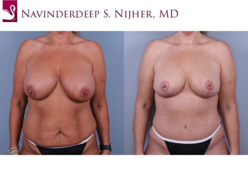 Breast Augmentation with Mastopexy (Breast Lift) Case #74532 (Image 1)