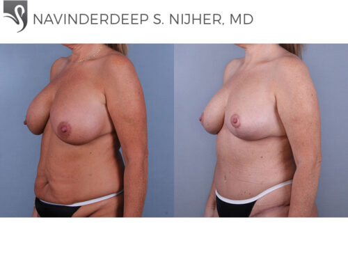 Breast Augmentation with Mastopexy (Breast Lift) Case #74532 (Image 2)