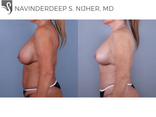 Breast Augmentation with Mastopexy (Breast Lift) Case #74532 (Image 3)