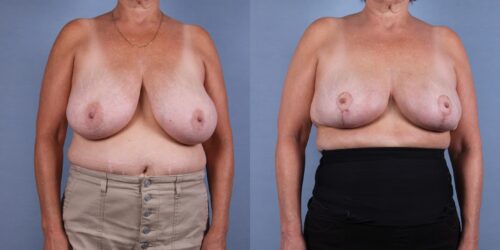 Female Breast Reduction Case #75739 (Image 1)