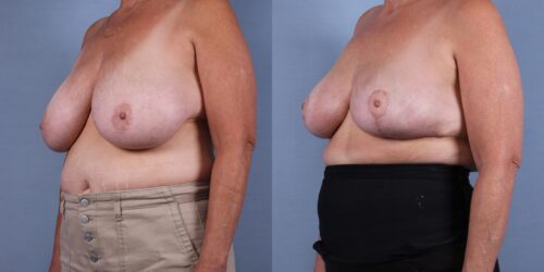 Female Breast Reduction Case #75739 (Image 2)